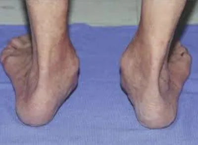 Tibialis Posterior Tendon Dysfunction