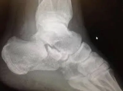 Calcaneal Fracture