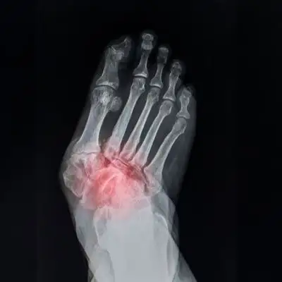 Charcot Arthropathy