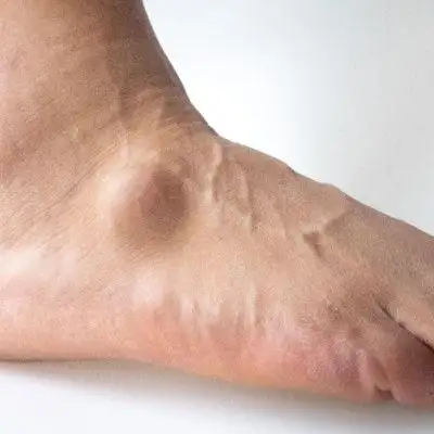 Ganglion Cyst