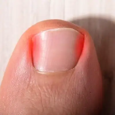 Ingrown Toenails