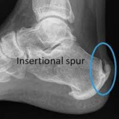 Insertional Achilles Tendinopathy