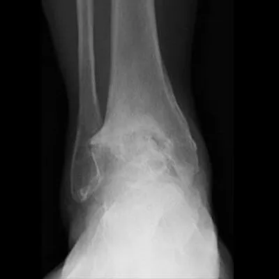 Ankle Arthritis