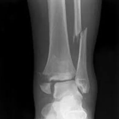 Ankle Fracture