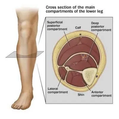 Compartment Syndrome