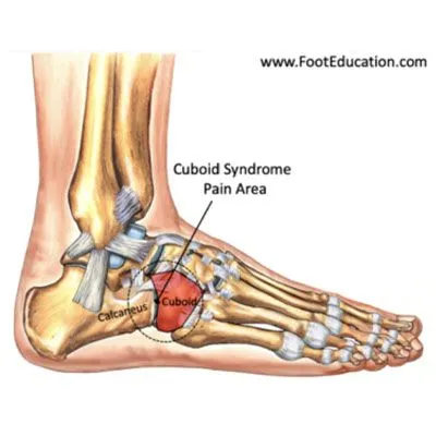 Cuboid Syndrome