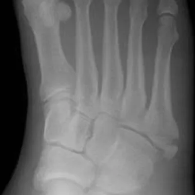 Dancer’s Fracture