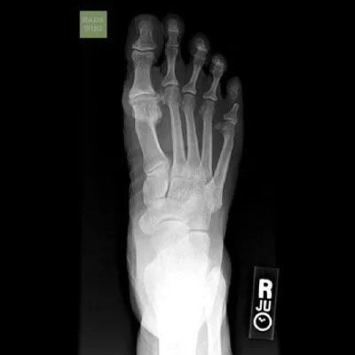 Hallux limitus/Rigidus