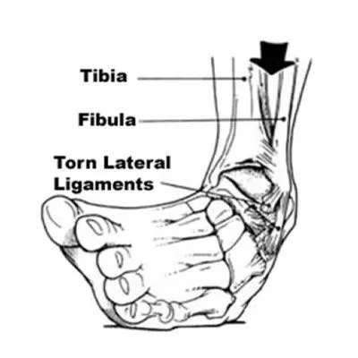 High Ankle Sprain