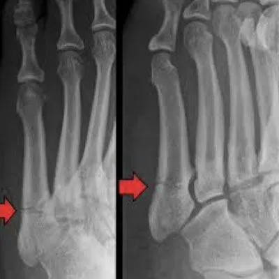 Jones Fracture