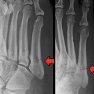 Metatarsal Fracture