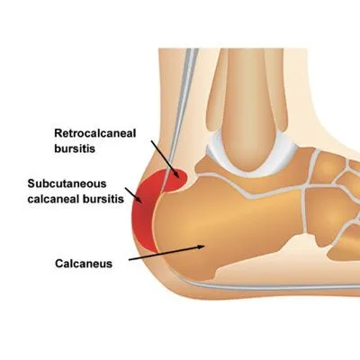 Subcutaneous Calcaneal Bursitis