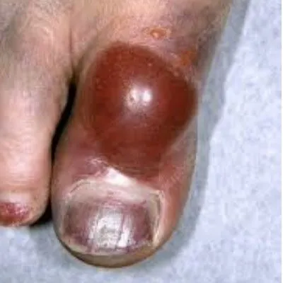 Toe Fracture