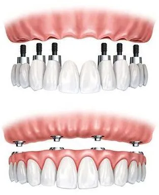 illustrations of fixed implant dentures and implant-supported dentures, Salem, OR implant dentistry