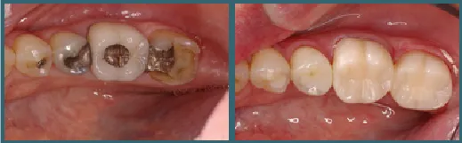 smile- before and after