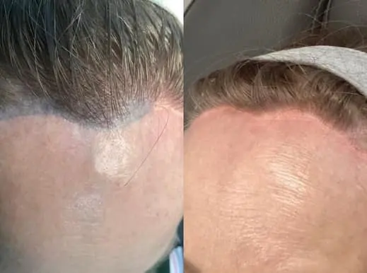 Hairline tattoo removal