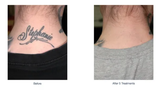 Laser Tattoo Removal  PiQo4 Laser  Beautologie Fresno  Facebook