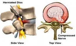 herniateddisc2.jpg