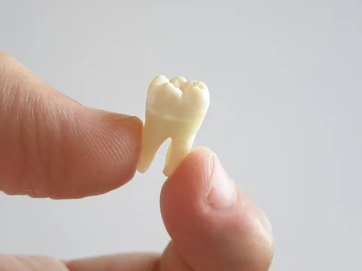 Photograph of close up of someone holding a tooth | Extractions In Westminster, CO