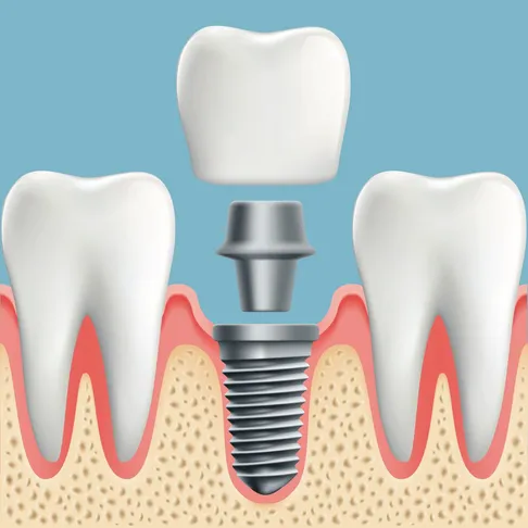 Dental Implants