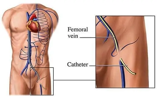cathter insertion