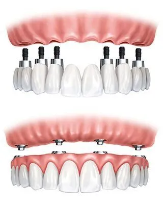 image of dental implants replacing full arch of upper teeth and image of removable dentures being supported by implants, dentist Decatur, IL dental implants