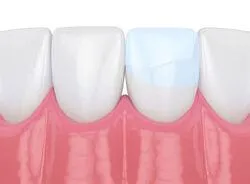 illustration of teeth, one cracked tooth repaired with dental bonding, Sherman Oaks, CA dentist