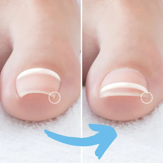 Ingrown Toe Treatment