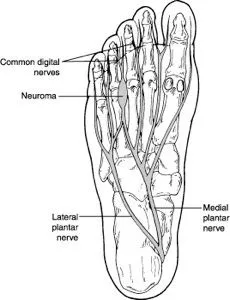 neuroma1.jpg