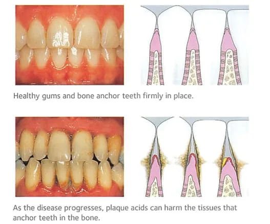 Gum Disease and teeth become loose 