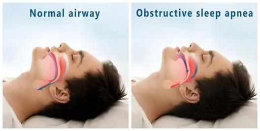 Illustration showing normal airway and airway affected by sleep apnea