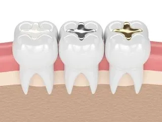 illustration of three teeth each with a different dental filling in it, dental fillings Lincoln, NE dentist 