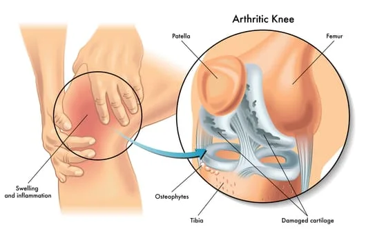 arthritic knee