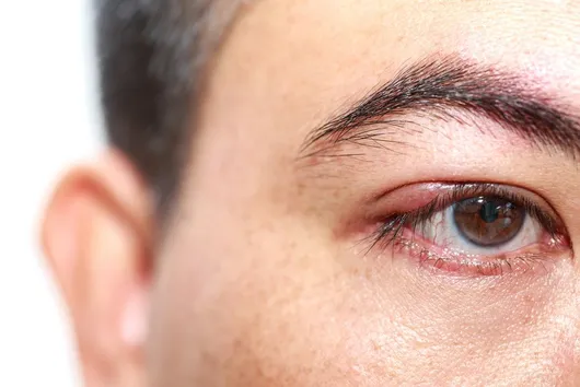 Man With Potential Case Of Pink Eye