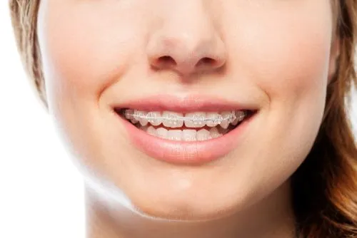 Ceramic Braces - Scarborough Orthodontics