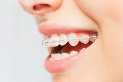 side profile of woman's smiling mouth, teeth have clear braces, Kearney, NE orthodontist