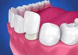 illustration of dental veneer piece being placed over front of lower tooth, cosmetic dentistry Hayward, CA veneers