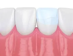 row of teeth, one tooth with crack repaired by dental tooth bonding Novi, MI dentist