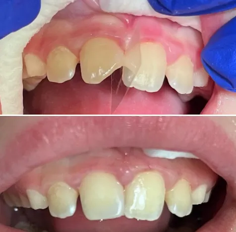 Implant restorations