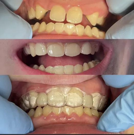 Implant restorations