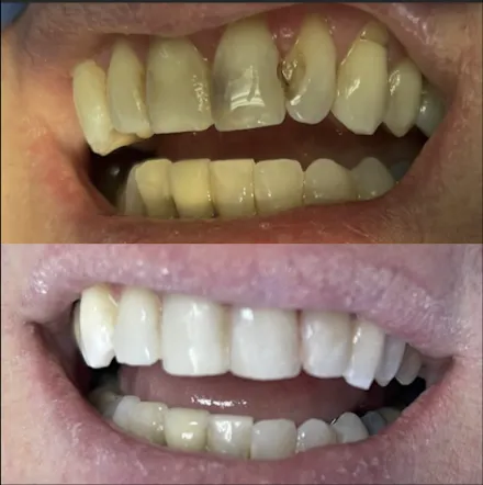 Implant restorations