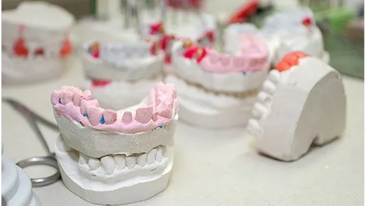 Dental Implants