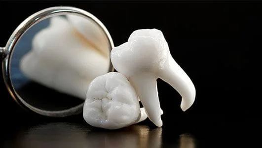 Tooth Extraction/Wisdom Teeth