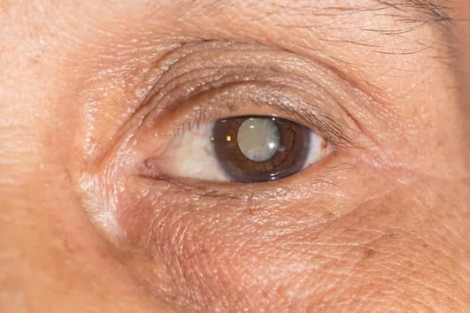 Cataract Treatment