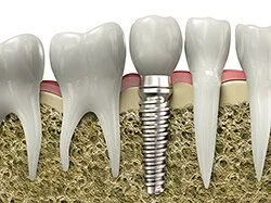 model of teeth and embedded dental implants Selmer, TN family dentist