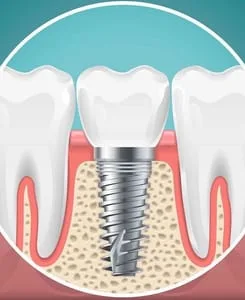 Single Tooth Dental Implant 