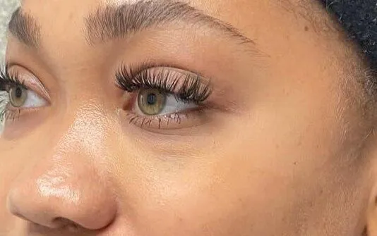 After Under Eye / Tear Trough Filler