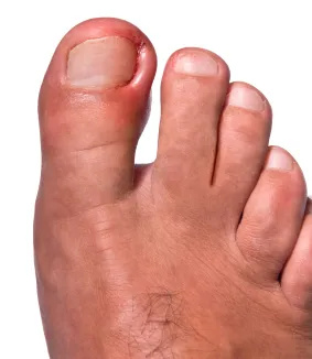 Ingrown toenail