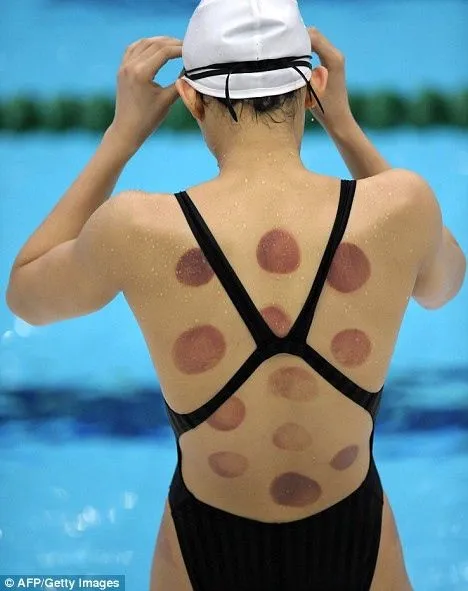 Cupping