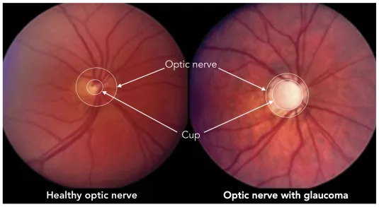 healthy optic nerve vs glaucomatous optic nerve